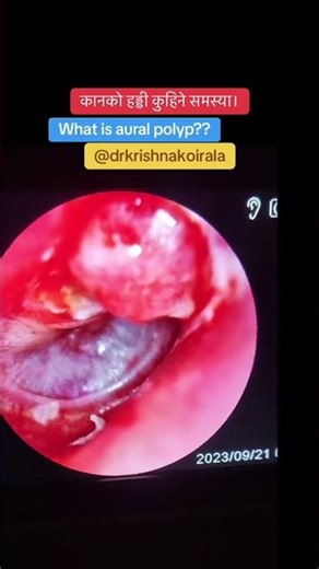 #onthisday #csom #auralpolyp #drkrishnakoirala #entdoctorpokhara