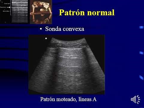 Ecografia Pulmonar. Curso Superior de Emergencias - Lujan