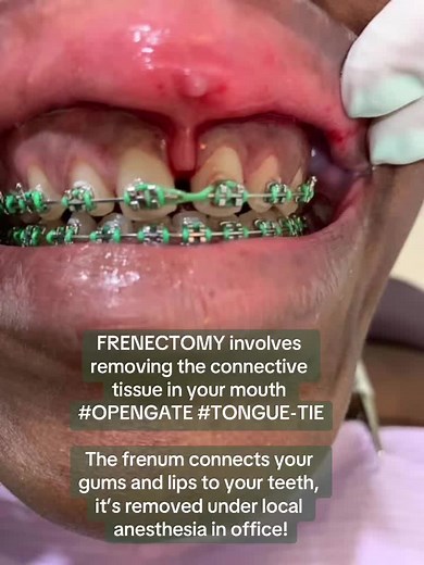 #frenulectomy #frenectomy #tiedtongue #opengate #diastema #tonguetie #ankyloglossia Frenulectomy is surgery to remove a small piece of tissue called the frenulum. You may need surgery if the frenulum attached to the center of your upper lip is too thick and causes a large gap between your teeth. This can lead to your gums being pulled too far off your teeth. A Frenectomy can potentially change your smile by improving facial aesthetics and the alignment of teeth.