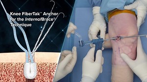 Knee FiberTak® Anchor With FiberTape® Suture for the InternalBrace™ Technique