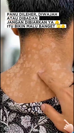 Obat Panu, Kutu Air, Kadas, dan Kurap Ampuh — Tips Pakai #Panuloss