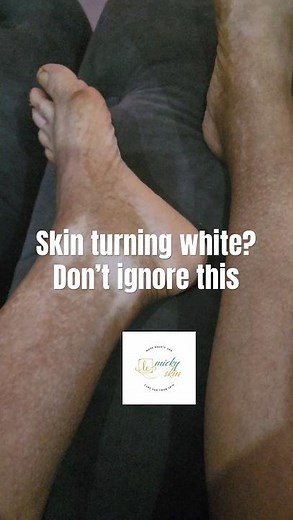 White Spots on Skin? Here’s the Truth!