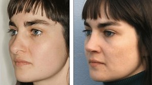 Revision Rhinoplasty to Correct a Hanging Columella: See This Young Woman's Before & After