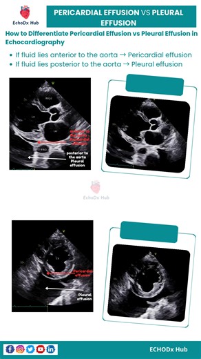 EchoDx Hub 🫀 on Instagram: "🫀 Pericardial vs Pleural Effusion (Echo Tips) 🔹 Key Difference – PLAX View: Pericardial Effusion: Fluid anterior to the descending aorta Pleural Effusion: Fluid posterior to the descending aorta 🔹 Other Clues: Pericardial: Encircles heart, may cause RA/RV collapse Pleural: Behind left atrium, doesn’t surround heart 🔹 Mnemonic: 👉 “A before A – Pericardial before Aorta; P behind Aorta – Pleural” #EchoDxHub #Echocardiography #PericardialEffusion #PleuralEffusion #C