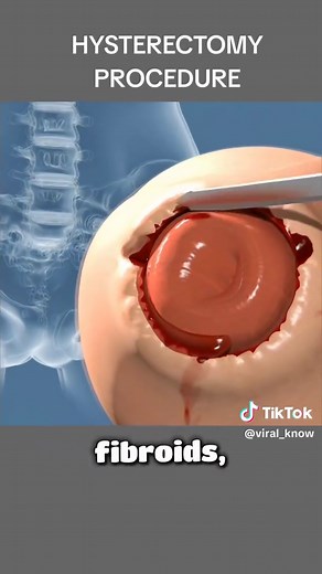 Hysterectomy Procedure Explained | 3D Medical Animation : #Hysterectomy #WomensHealth #MedicalAnimation #SurgeryExplained #3DAnimation #HealthEducation #Gynecology