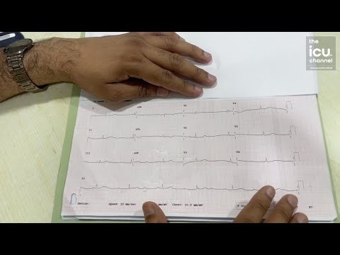 Always rule out this cause in Complete Heart Block (CHB)
