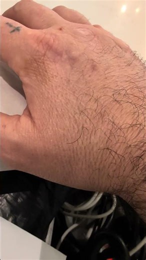 hand Twitch #bfs Benign fasciculation Syndrome