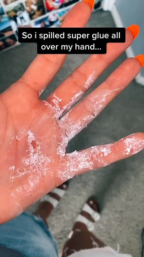 How to Remove Super Glue from Your Skin