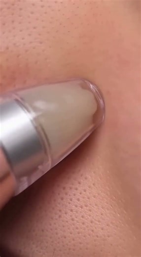 Extreme Blackhead and Sebum Vacuum Removal