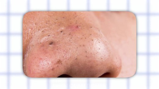 Why your blackheads keep coming back: hidden causes and fixes explained