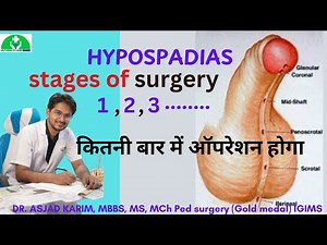 HYPOSPADIAS Surgery Secrets REVEALED