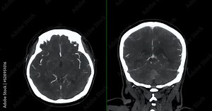 CTA brain or Computed tomography angiography of the brain comparison axial and coronal plane for finding Stroke and aneurysm disease .