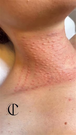 Inna Chornokan | TOP BBL injector | lips & botox on Instagram: "Neck Rejuvenation Care: Hyaluronic Acid + Polynucleotide Injections ✨ Give your neck the same level of care as your face. This treatment deeply hydrates, firms, and restores the delicate skin of the neck — reducing crepiness, fine lines, and signs of aging. ✨ What it does: • Boosts hydration and elasticity • Improves skin texture and smoothness • Stimulates regeneration with powerful polynucleotides • Creates a firmer, younger-looki