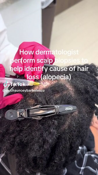 Wondering what happens during a scalp biopsy for hair loss? 🤔✨ Here’s the quick breakdown ⬇️ 1️⃣ We numb the area — a tiny injection of lidocaine so you don’t feel pain. 2️⃣ A small punch tool (usually 4 mm) gently removes a sample of the scalp. 3️⃣ One or two stitches are placed so it heals smoothly. 4️⃣ Your sample goes to a dermatopathologist who analyzes the follicles under a microscope. 5️⃣ Results guide your treatment — helping differentiate scarring vs non-scarring hair loss, telogen eff