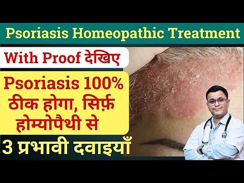 3 BEST Homeopathic Medicine to CURE your PSORIASIS!