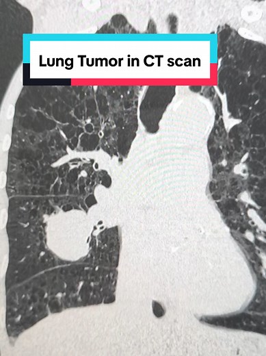 Understanding Lung Tumors in CT Scans