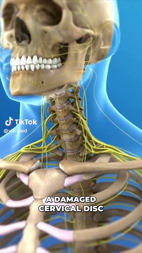 Mobi-C Prosthetic Device for Cervical Spine Surgery