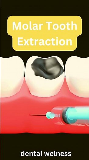 Tooth Extraction
