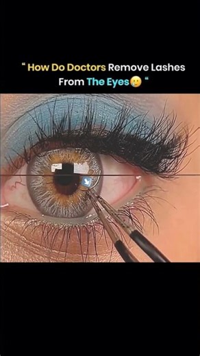 How Doctors Remove Eyelashes from the Eye 👁️😳