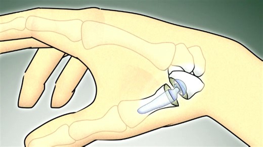 Gesundheit!: Moderne Prothesen für schnellere Genesung