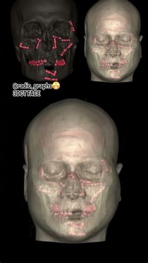 3dct face #anatomy #ctscan #xray #doctor #nurse #viral #tranding #mri #science #student #study #xray