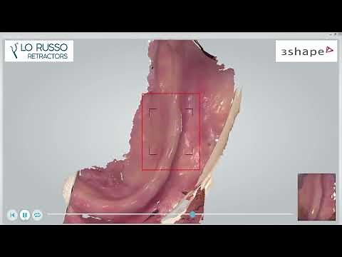 Live scanning edentulous mandible with Lo Russo Retractors