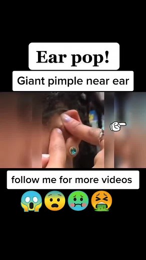 percer gros bouton douloureux