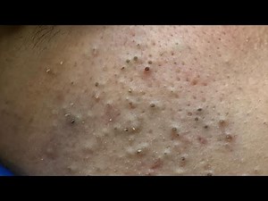 Deep Blackhead Extraction | Korean Skincare Routine for Acne