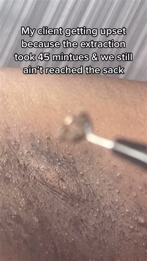 Smooth Extraction Process for Vaginal Pimples | Galaxy Extraction