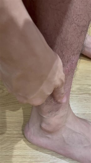 Effective Relief for Psoriasis with Amgevita Treatment