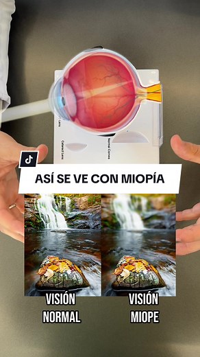 La Miopía: Definición, Causas y Tratamientos