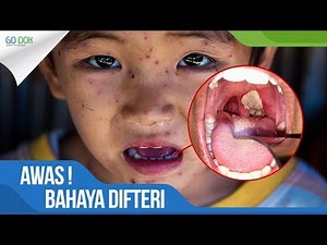 AWAS! BAHAYA DIFTERI yang Berdampak pada KEMATIAN Sedang Mengincar ANDA! / Go Dok Indonesia