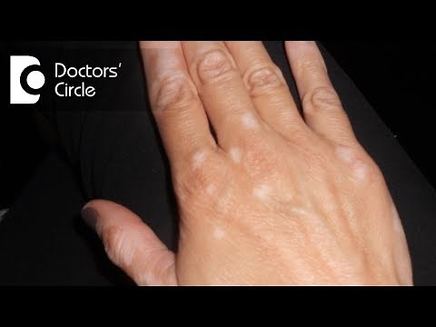 Causes of discoloured patches on skin?-Dr. Nischal K