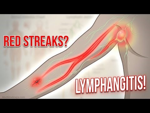 Lymphatic System & Lymphangitis Explained | Anatomy, Physiology & Clinical Correlates