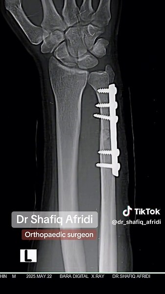 Understanding Ulna Fractures: Expert Insights by Dr. Afridi