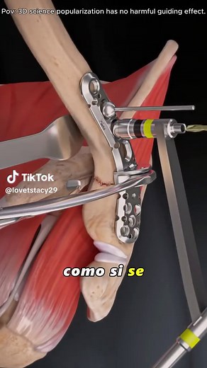 Understanding Broken Collarbone Treatments with 3D Animation