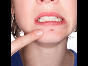 QUICK MAKEUP TIP - ACNE TREATMENT