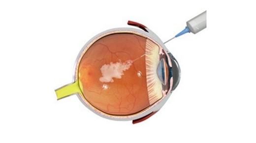 Advancements in the treatment of Geographic Atrophy