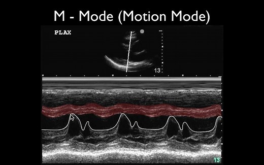 超声M模式基本原理||Ultrasound M-Mode