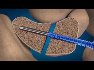 REDUCT Headless Compression Screw