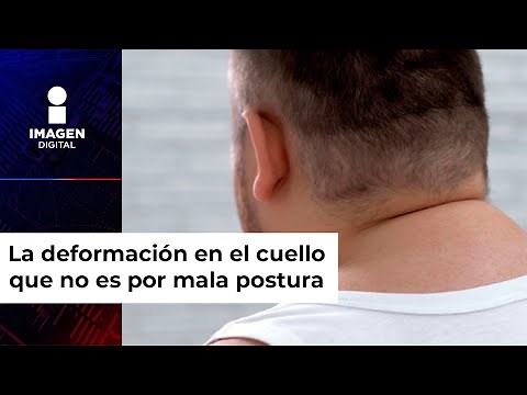 Joroba Búfalo: Más que mala postura