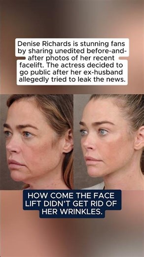 Denise Richards Shares Before and After Facelift Photos in Rare Reveal