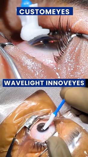Custom Eyes vs Wavelight Innoveyes — Which is Better for Your Eyes?