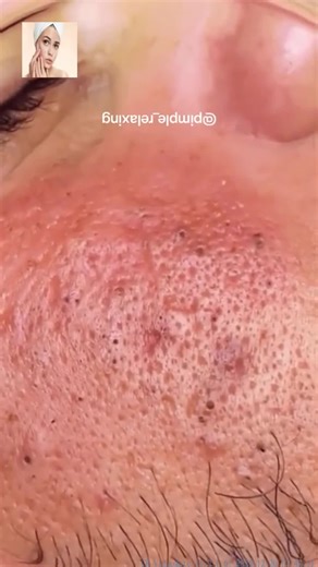 How to Effectively Remove Pimples and Achieve Clear Skin