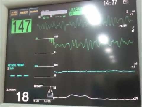 心電図モニター 実際の測定 VFIB(心室細動) [NIHONKOHDEN LifeScope I]