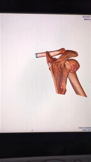 RIGHT SHOULDER 3D...? #ctscan #ct #anatomy