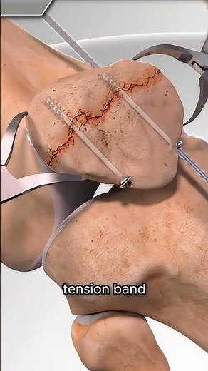 How Doctors Fix a Broken Kneecap Step by Step!