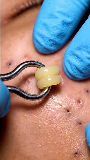 Ultimate Blackhead Vacuum Removal | Deep Facial Clean