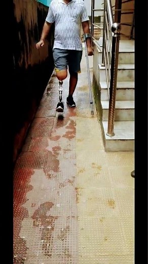 Knee Disarticulation Prosthesis- Practice Session