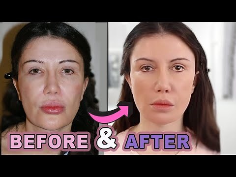 My Face Lift Before and After: Part 2